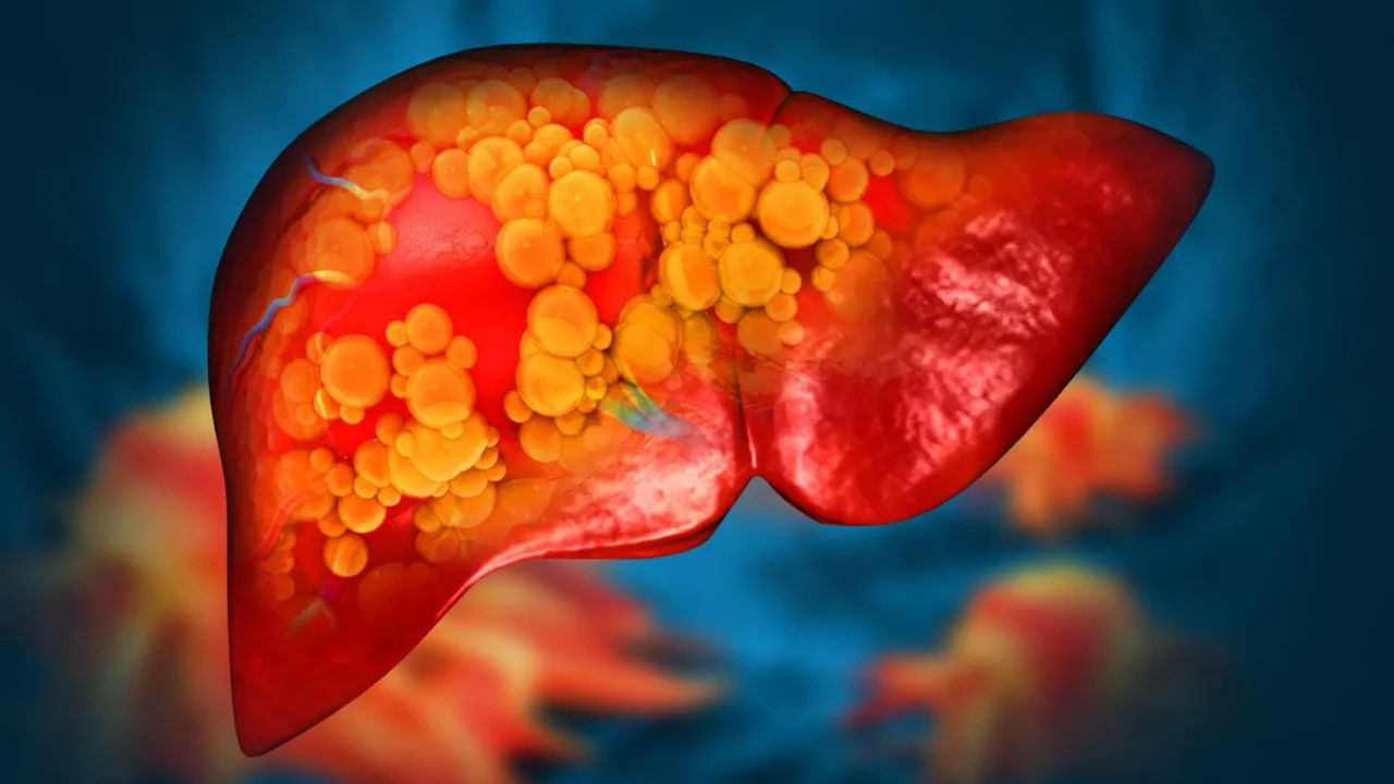 Mayo Clinic discovers rare gene mutation that causes fatty liver disease