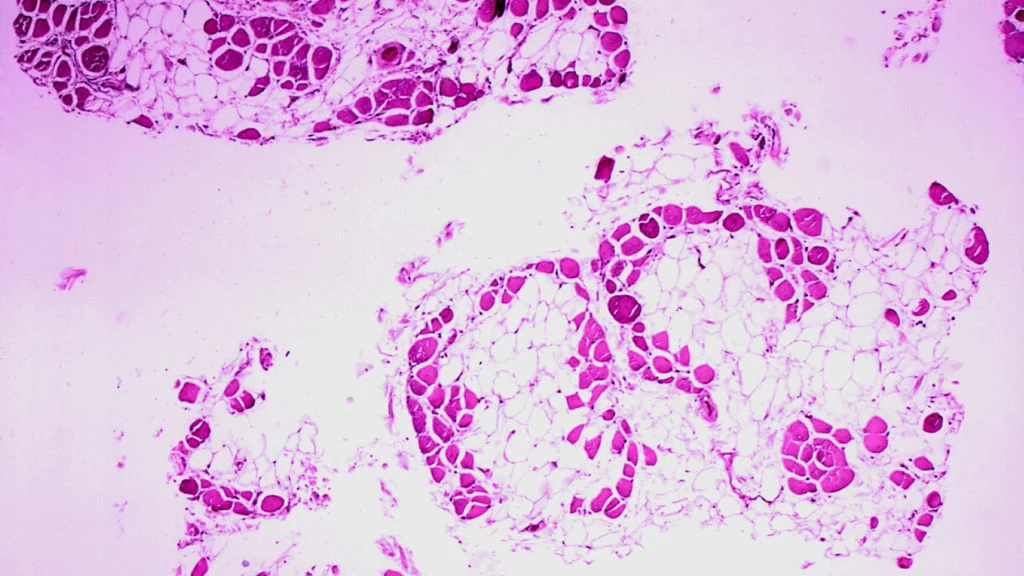 FDA Advisory Committee Confronts Dueling Narratives Over Capricor’s Duchenne Muscular Dystrophy Cell Therapy.
