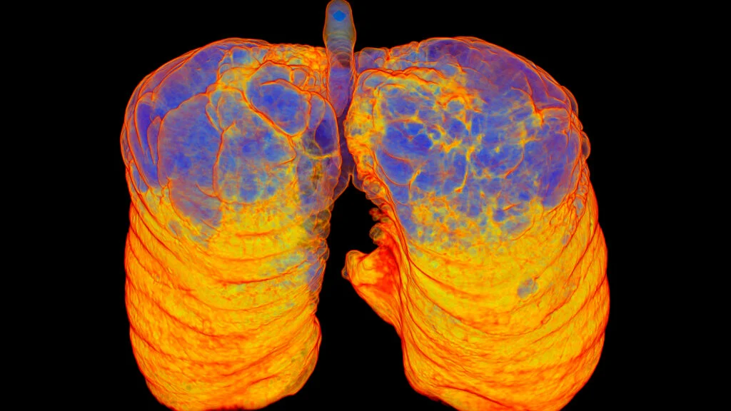AstraZeneca’s Tozorakimab Hits Key Goals in Phase 3 COPD Trials, Signaling a Potential Blockbuster Shift in Respiratory Care.