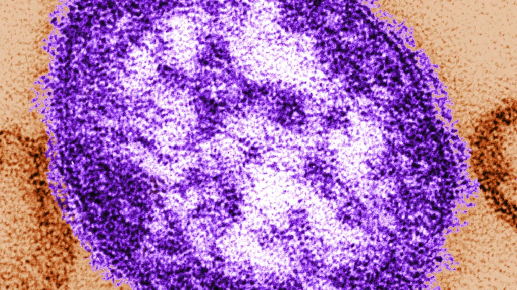 Lancaster County Coroner Confirms Measles as Primary Cause in Death of Pennsylvania Infant Amid National Political Controversy.